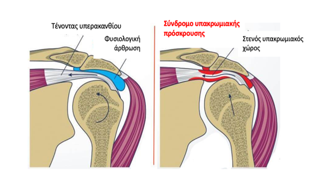 ΣΥΝΔΡΟΜΟ ΠΡΟΣΚΡΟΥΣΗΣ ΩΜΟΥ