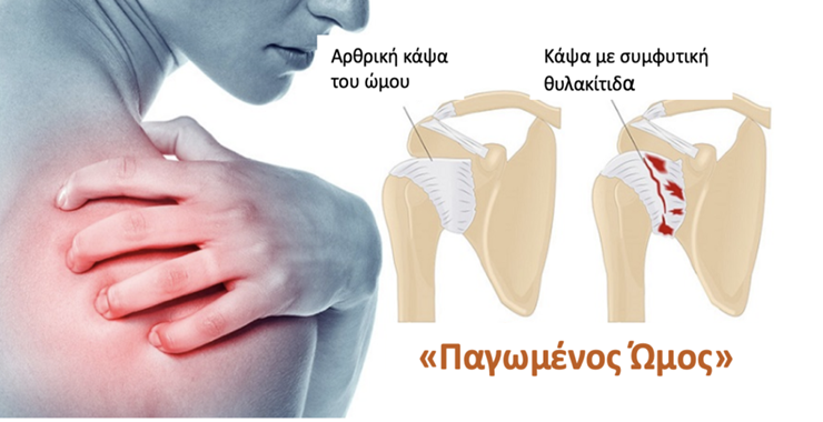 ΣΥΜΦΥΤΙΚΗ ΘΥΛΑΚΥΤΙΔΑ ( ΠΑΓΩΜΕΝΟΣ ΩΜΟΣ)