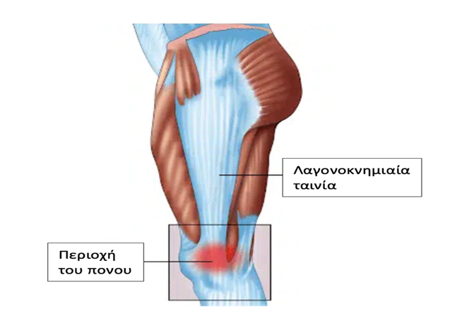 ΣΥΝΔΡΟΜΟ ΛΑΓΟΝΟΚΝΗΜΙΑΙΑΣ ΤΑΙΝΙΑΣ